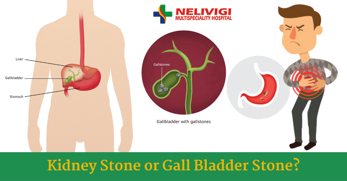 Kidney or gallbladder stones | Nelivigi Multispecaility Hospital in Bellandur