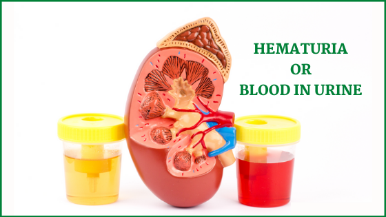 Hematuria or Blood In Urine Treatment in Bellandur