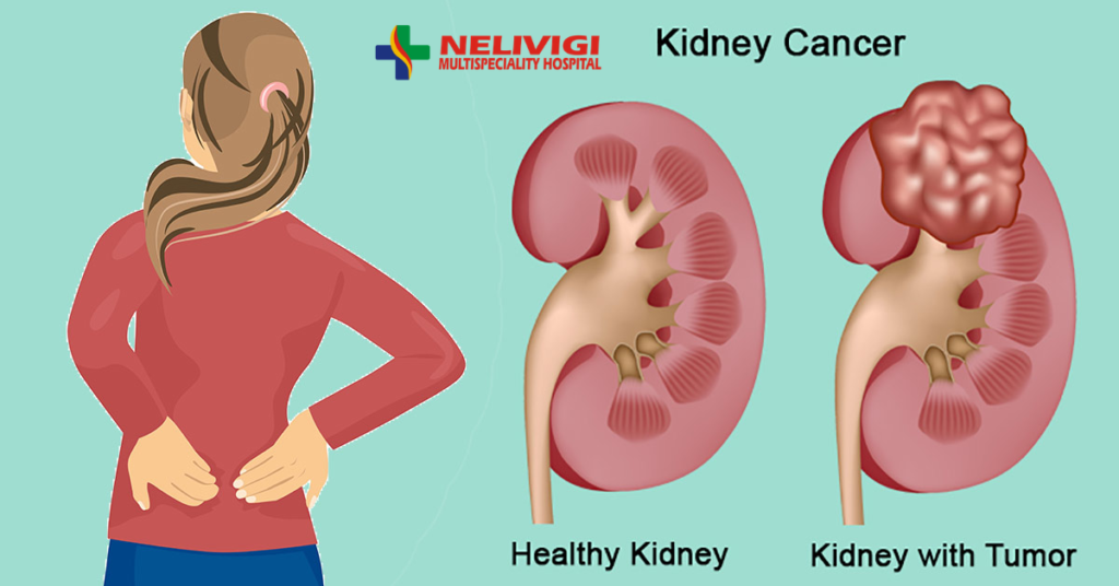 Treatment for RCC or kidney cancer | Renal Cell Cancer Treatment in Bangalore | Nelivigi Multispeciality