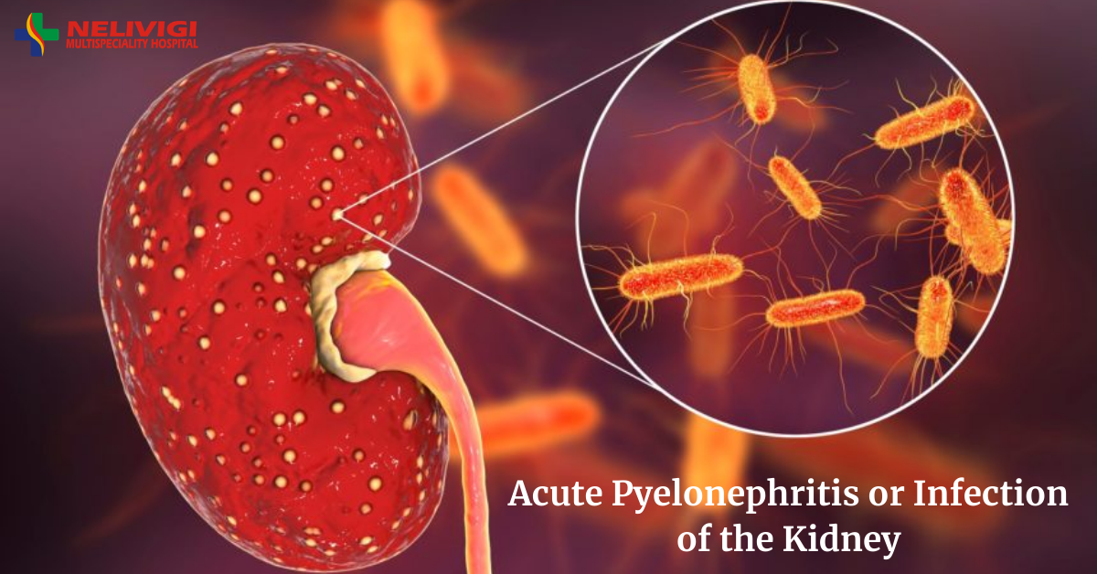 Acute Pyelonephritis or Infection of the Kidney